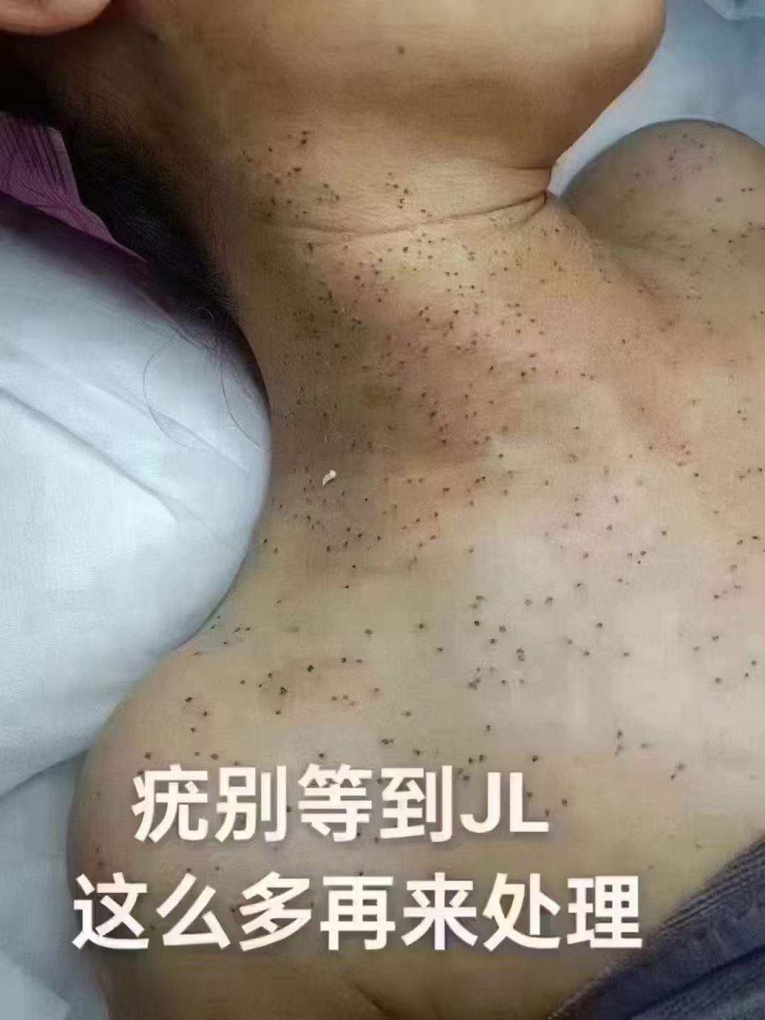 脖子上长丝状疣原因图片