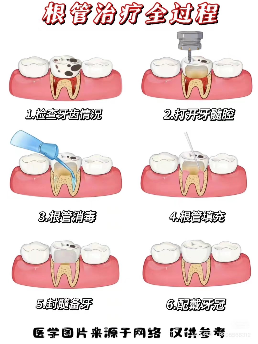 牙齿根管治疗图片步骤图片