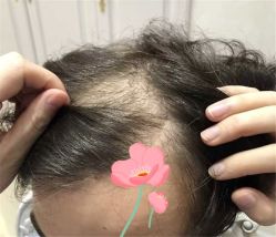 点击看大图 -大麦微针植发全国连锁