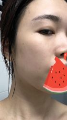 体验后-美瑞莎创美医疗美容