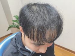 体验后-大麦微针植发全国连锁