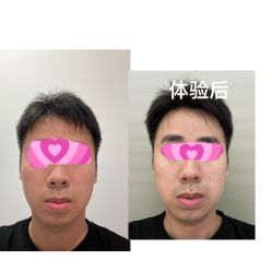 体验前-深圳鹏爱悦心医疗美容医院
