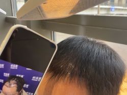 -碧莲盛·不剃发植发