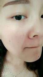 半年左右-美丽人生祛斑扁平疣汗管瘤中心