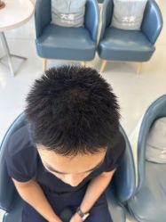 -大麦微针植发全国连锁