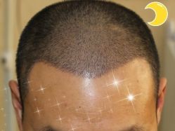 -大麦微针植发丨全国连锁