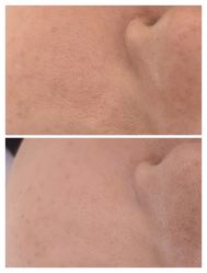 体验前-光SPA科技美肤