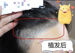 -大麦微针植发全国连锁
