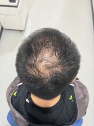 -大麦微针植发全国连锁