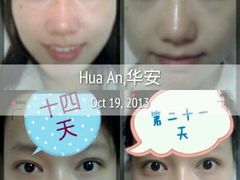 术后三周-上海华安整形外科门诊部