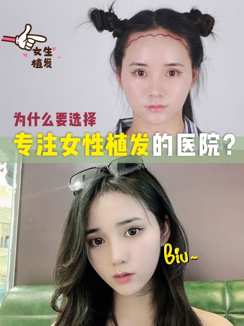 女人植发教程视频(女性植发 贴吧)