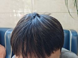 -大麦微针植发全国连锁