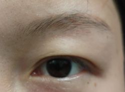 体验后-成都西区医院整形美容