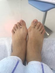 点击看大图 -派恩宜灰指甲鸡眼嵌甲手足癣