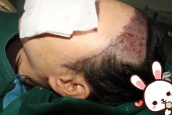 点击看大图 -大麦微针植发丨全国连锁