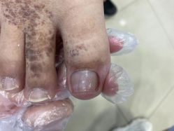点击看大图 -德哥灰指甲脚气甲沟炎跖疣护理