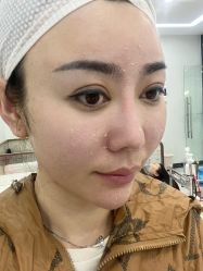 体验后-悟空祛痘·诺奖技术专业店