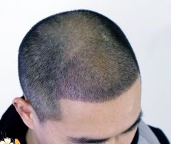 -大麦微针植发丨全国连锁