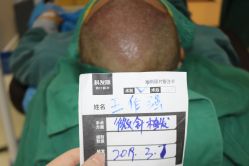 -大麦微针植发丨全国连锁