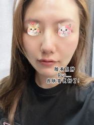 体验后-More摩尔医美の注射线雕光电中心
