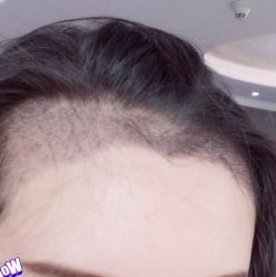 -大麦微针植发丨全国连锁