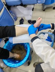 -德哥灰指甲脚气甲沟炎跖疣护理