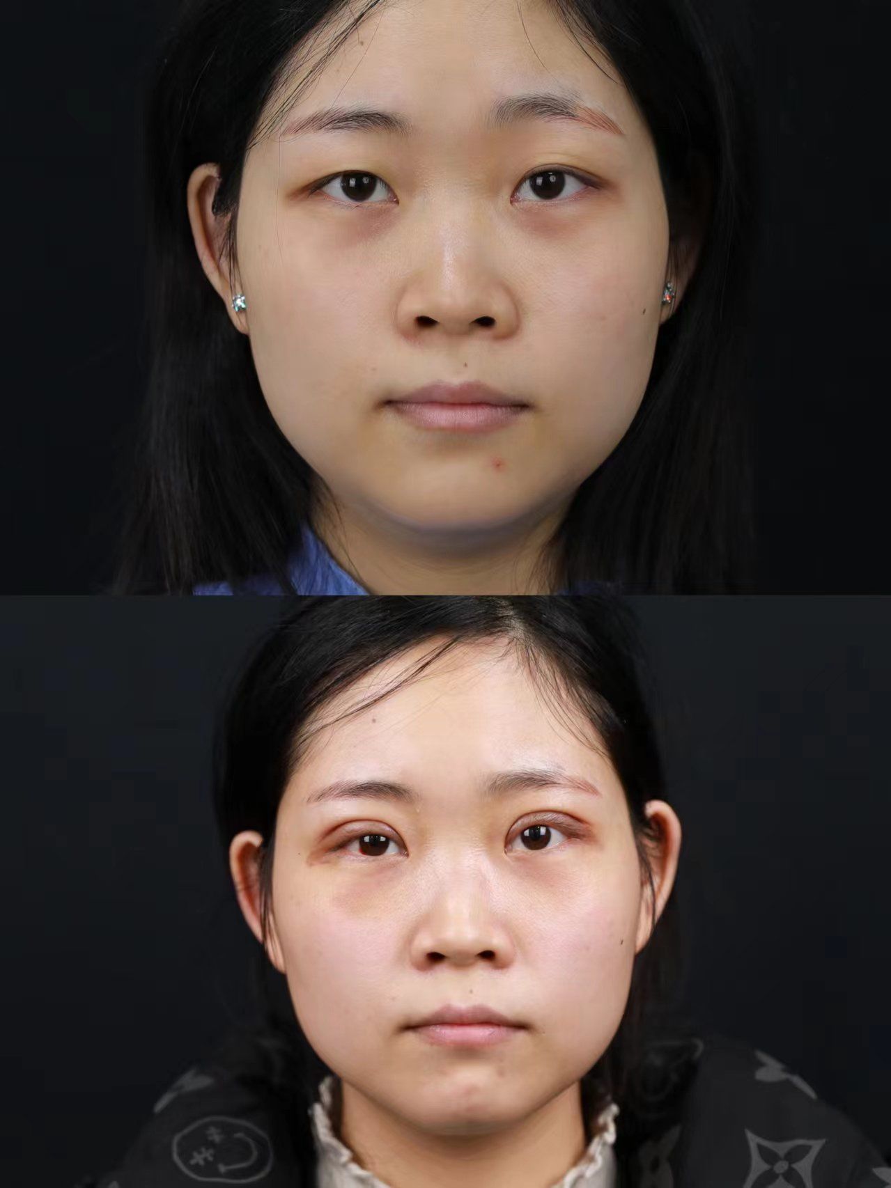 整形前后大对比