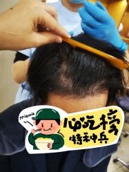 -大麦微针植发全国连锁