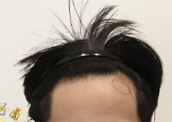 -大麦微针植发全国连锁