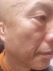 体验后-北京美痣堂古方祛痣斑疣瘊