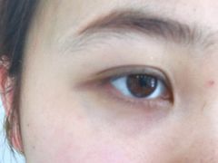 -黑马眼科·近视手术