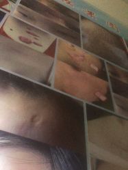 -痣斑堂·取大痣