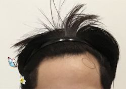 -大麦微针植发全国连锁