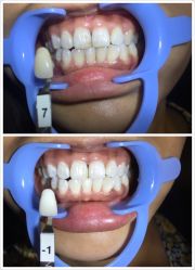 牙齿美白-光SPA科技美肤