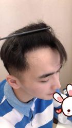 点击看大图 -大麦微针植发丨全国连锁