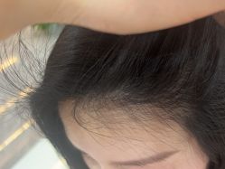 -碧莲盛·不剃发植发