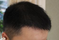 -大麦微针植发丨全国连锁