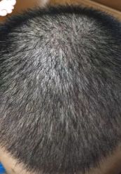 -大麦微针植发丨全国连锁