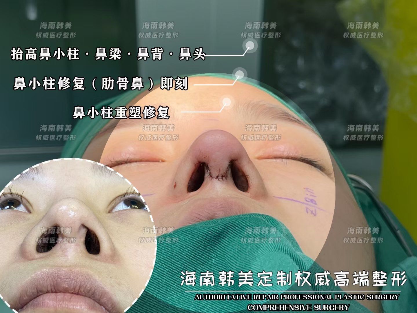 鼻小柱修复即刻90
完美鼻小柱抬高修