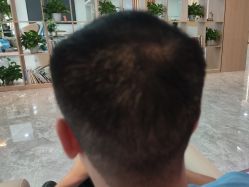 -碧莲盛·不剃发植发