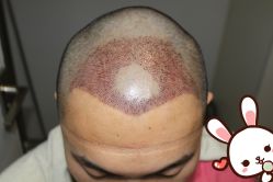 -大麦微针植发丨全国连锁