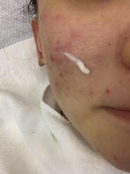 -悟空祛痘·诺奖技术专业店