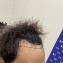 -碧莲盛·不剃发植发
