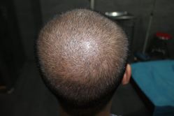 点击看大图 -大麦微针植发丨全国连锁