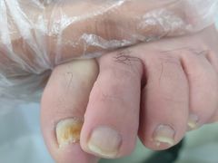 -新甲连锁甲沟炎灰指甲手足癣(中央大街店)