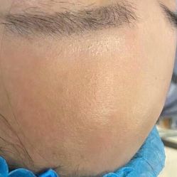 体验后-成都苗方清颜专业祛痘