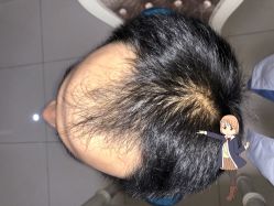 -大麦微针植发丨全国连锁