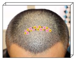 -大麦微针植发全国连锁