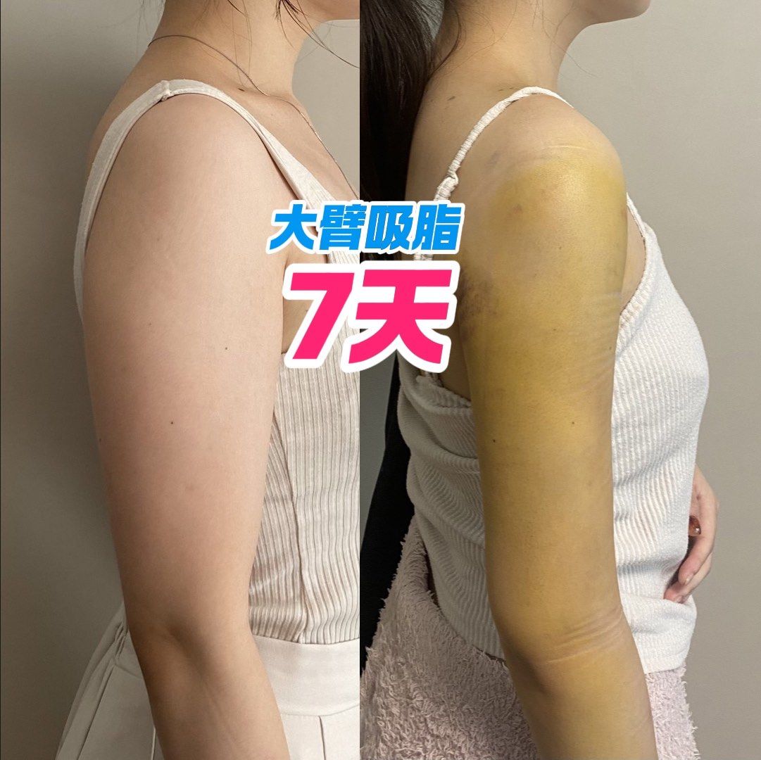 手臂吸脂
