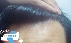 -大麦微针植发丨全国连锁